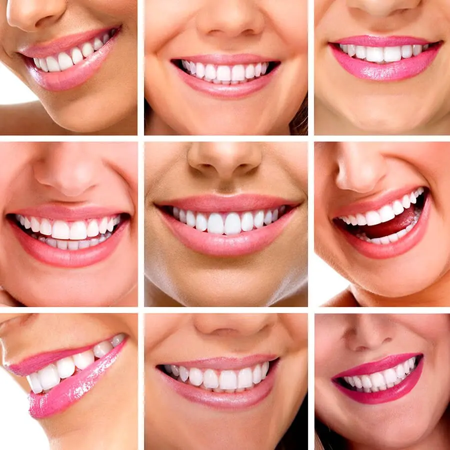 Carillas dentales moda: una sonrisa impecable al estilo de los famosos - Cuál es la mejor carilla para los dientes carillas dentales moda - Cuál es la mejor carilla para los dientes