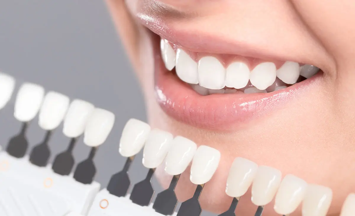Carillas dentales moda: una sonrisa impecable al estilo de los famosos - Cuánto cuesta ponerse carillas en España carillas dentales moda - Cuánto cuesta ponerse carillas en España