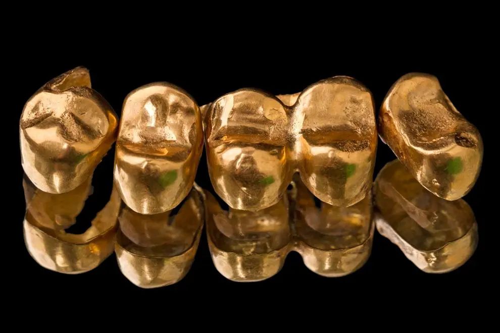 moda dientes de oro - Cuánto duran los dientes de oro