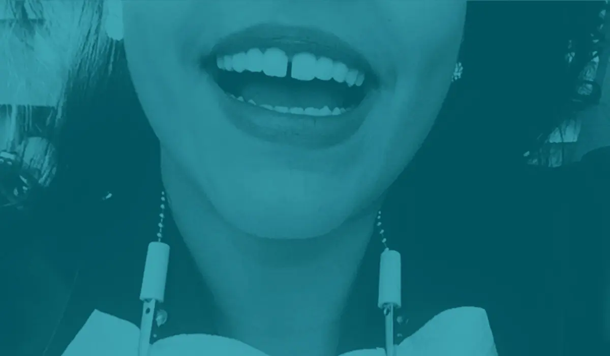 dientes de moda - Por qué se produce el diastema