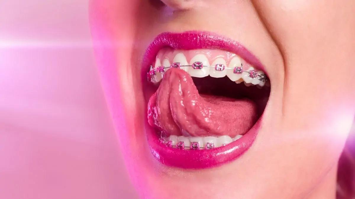 moda colores de brackets - Qué color de brackets se ven los dientes más blancos
