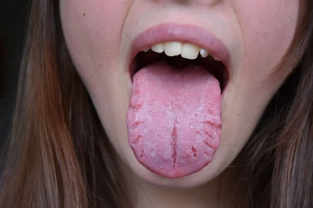 moda lengua partida - Qué es bueno para curar la lengua partida