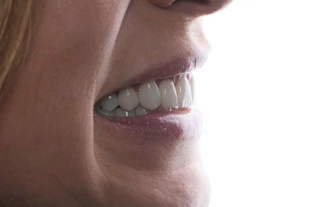 Carillas dentales moda: una sonrisa impecable al estilo de los famosos - Qué famosos tienen carillas dentales carillas dentales moda - Qué famosos tienen carillas dentales